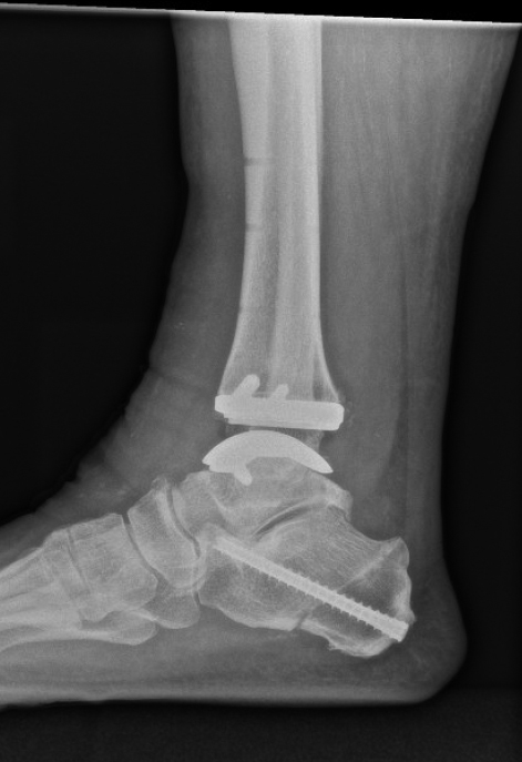 Seitliche Röntgenaufnahme des rechten Sprunggelenks mit eingesetzter Prothese und Fixierungsschraube im Fersenbein.